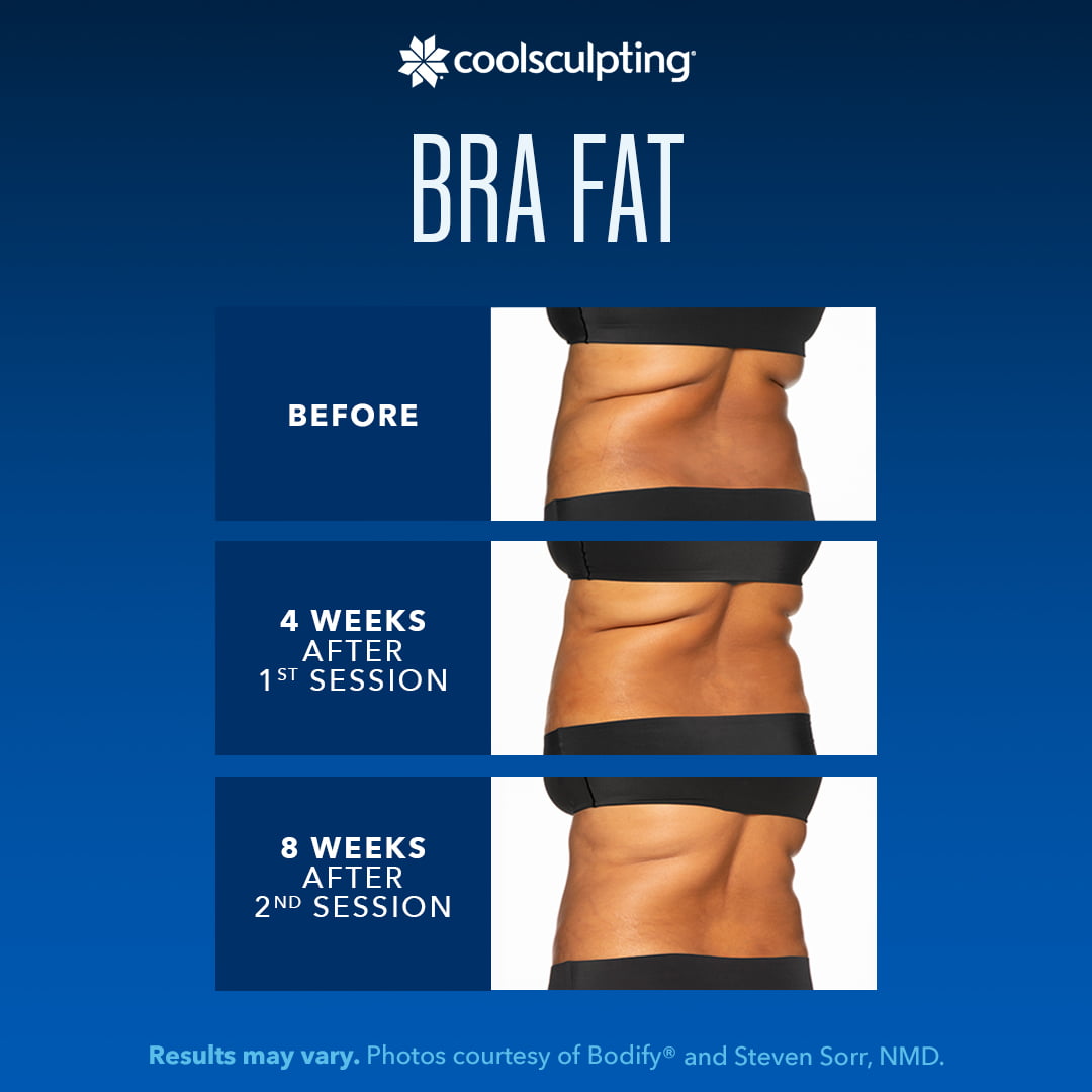before and after pics of coolsculpting results